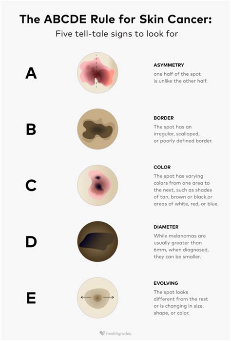 ABCDEs of Skin Cancer: Melanoma Symptoms