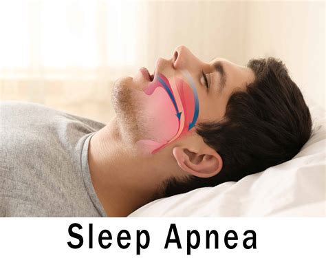 Sleep Apnea picture - VA Claims Insider