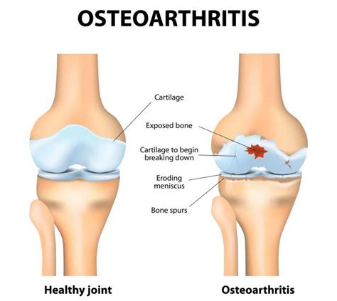 Knee Pain Treatment