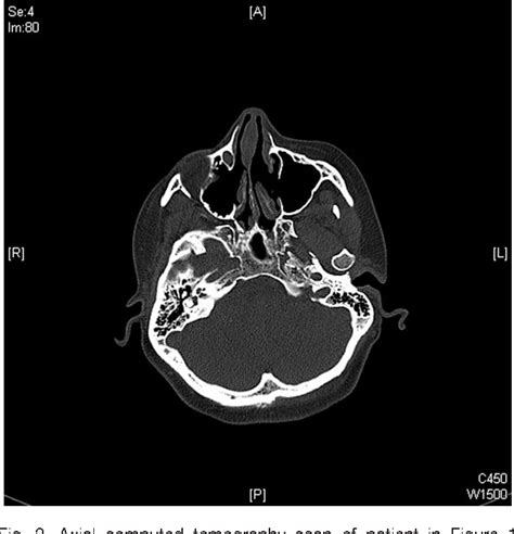 Paranasal sinus exostoses: possible correlation with cold temperature ...