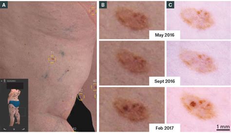 RACGP - Diagnosis and management of cutaneous melanoma