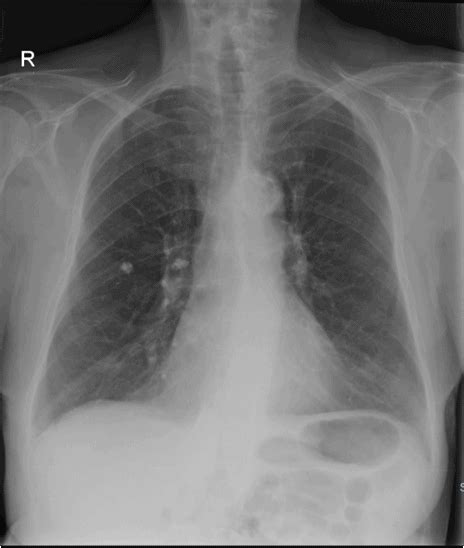 A 28-Year-Old Male with a Persistent Dry Cough - Journal of Urgent Care ...