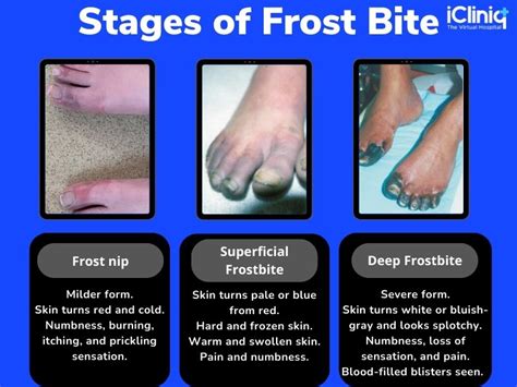 Frostbite - Causes | Symptoms | Risk factors | Complications ...