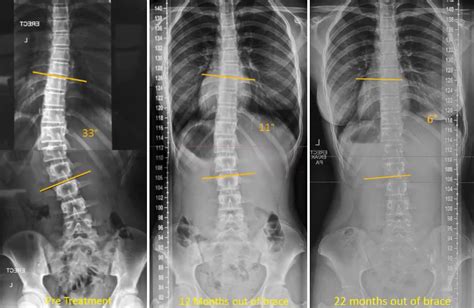 Scoliosis Treatment - Foundation Spine and Posture