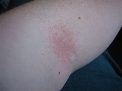 rash on inside of elbow - pictures, photos