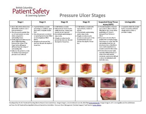 Pressure Ulcer Stages Pressure Ulcer Staging Pressure Ulcer Wound ...