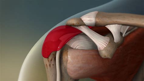 Shoulder Bursitis