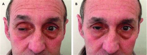 Ice-pack test. Right eye ptosis at baseline (A) and after applying ...