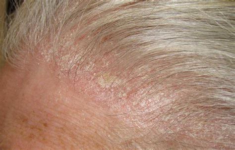 How To Treat A Scabby Scalp – DS Healthcare Group