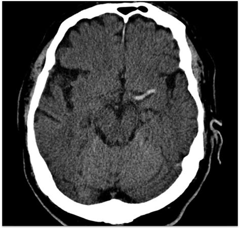 Radiology Signs | Radiology, Brain images, Ct brain