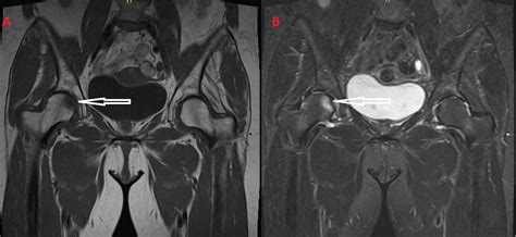 Cureus | Lower Limb Pain Attributed to Bone Marrow Edema Syndrome: A ...