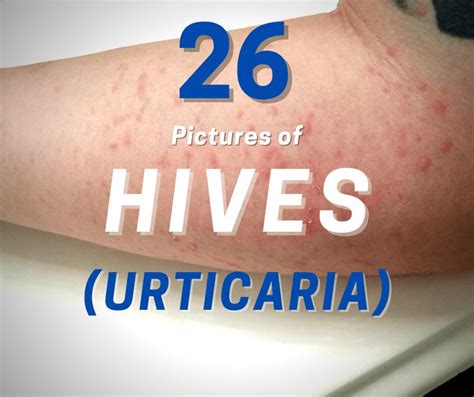 37 Detailed Pictures of Hives on Skin - Allergy Preventions | Food ...