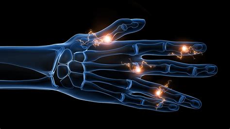 Rheumatoid Arthritis Flares: Causes, Treatments, Prevention | Everyday ...