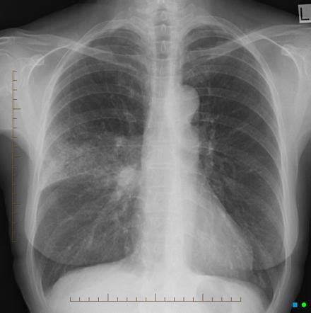 Minor Fissure Chest X Ray