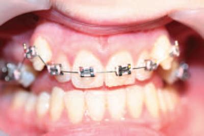 11: TOOTH ALIGNMENT WITH ORTHODONTIC BRACES | Pocket Dentistry