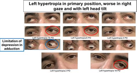 Trochlear Nerve Palsy Eye Position