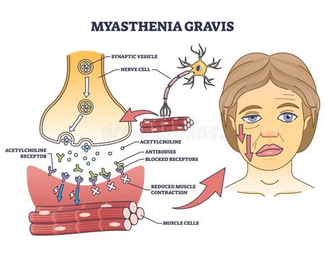 Myasthenia Gravis Symptoms Stock Illustrations – 8 Myasthenia Gravis ...