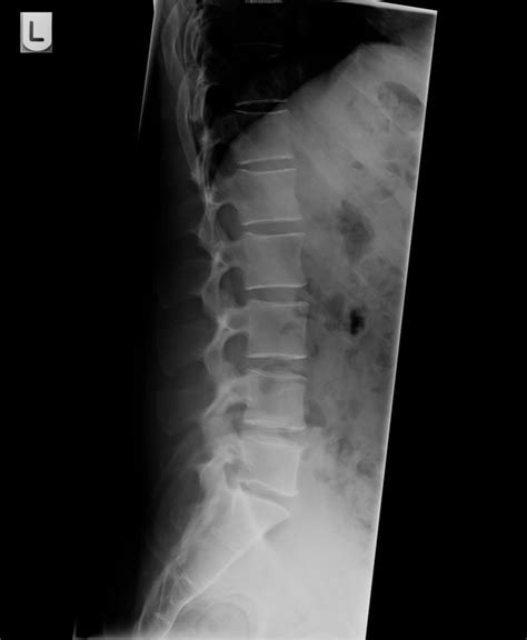 Thoracic Spine X Ray Lateral - cloudshareinfo