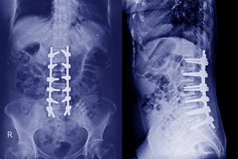 Degenerative Disc Disease: What is It and What's the Treatment Options ...