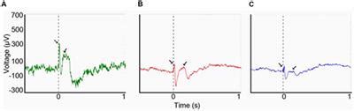 Frontiers | The Claustrum in Relation to Seizures and Electrical ...