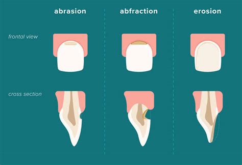 Best Tooth Erosion Treatment | Tooth Abrasion Dental Treatment