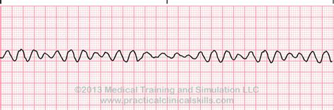 Ventricular Fibrillation ECG Interpretation with Sample Strip