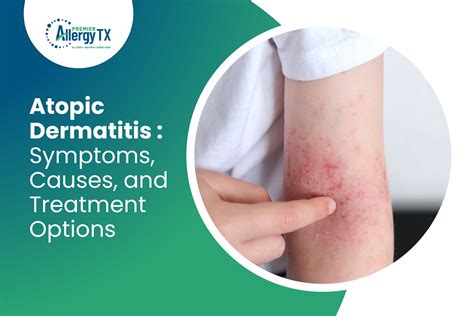 Symptoms, Causes, and Treatment Options for Atopic Dermatitis