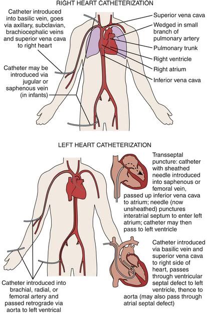 Introduction to the Catheterization Laboratory | Thoracic Key