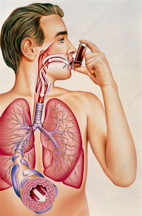 Artwork of effects of asthma inhaler on man's lung - Stock Image - M109 ...