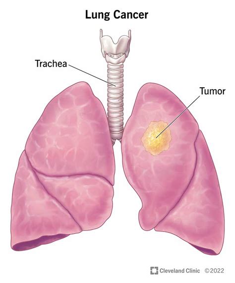 Lung Cancer: Types, Stages, Symptoms, Diagnosis & Treatment