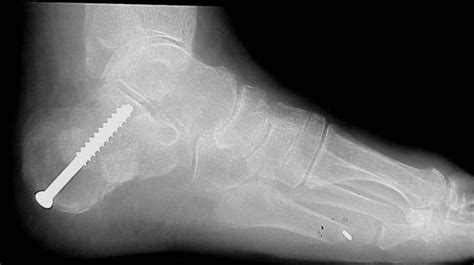 How To Address Subtalar Joint Instability