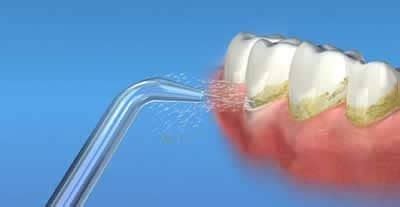 Flossing Alternatives: Water Flossing - Algodones Dentists Guide