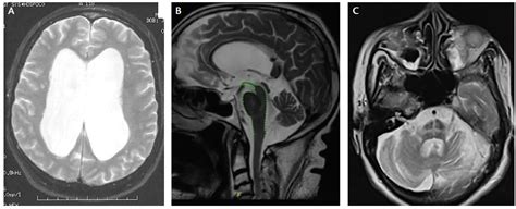 Imaging in Parkinson’s Disease - Practical Neurology