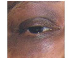 Pigmentary Disorders > Familial Racial Periorbital Hyperpigmentation