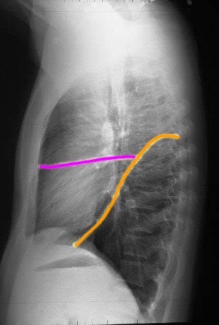 Minor Fissure Chest X Ray