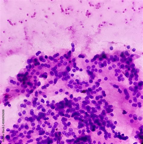 Thyroid nodule (FNA cytology): Cellular follicular lesion, microscopic ...