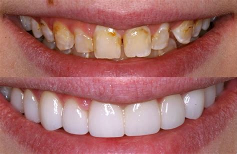 Veneers Before and After Photos - NewMouth