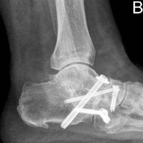 ankle-triple-arthrodesis - BallaratOSM | Ballarat Orthopaedics & Sports ...