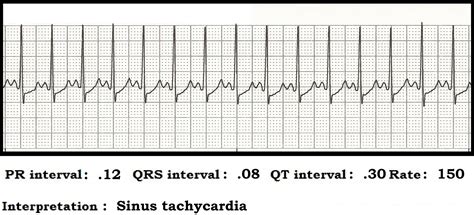 Float Nurse: ECG Rhythm Strip Quiz 89: Interval measurements