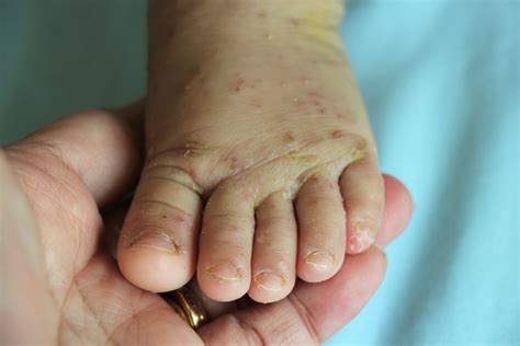 Scabies In Babies: Causes, Symptoms And Treatment - Being The Parent