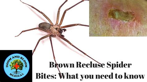 Brown Recluse Spider Bites: What you need to know - YouTube