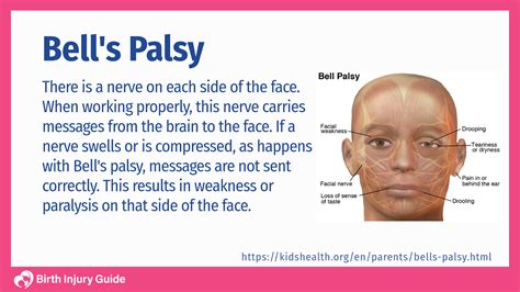 Bell's Palsy Handbook: Facial Nerve Palsy Or Bell's Palsy Facial ...