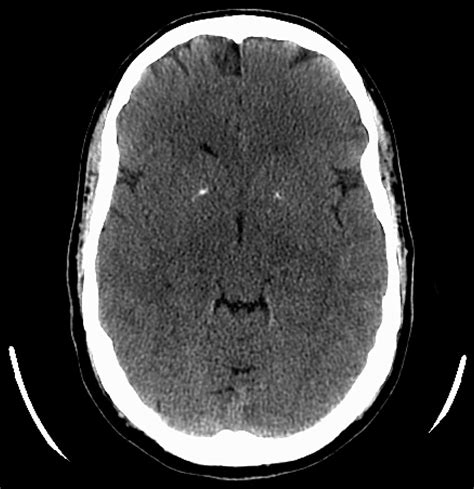 The Clinical Significance of Bilateral Basal Ganglia Calcification ...