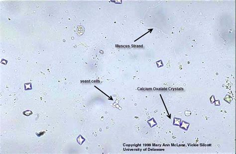 Calcium oxalate crystals | Medical Laboratories