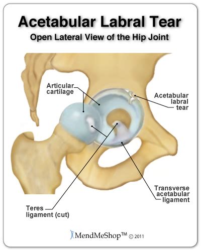 Acetabular Labral Tear - Hip Joint