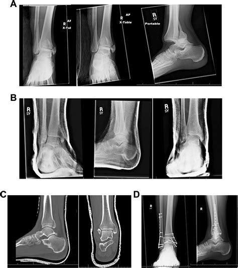 Displaced Trimalleolar Ankle Fracture