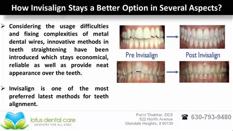 Best Invisalign Method for Teeth Alignment by www ...