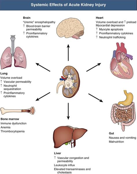 Acute Kidney Injury Diagram