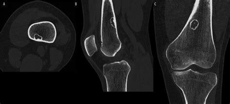 Fibrous Cortical Defect Symptoms, Images and Treatments | New Health ...