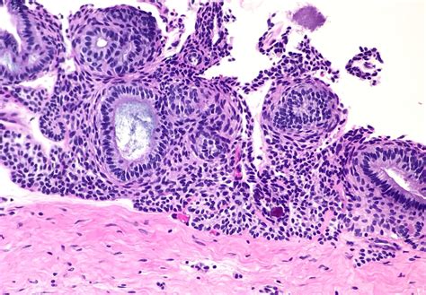 Pathology Outlines - Adenomatoid odontogenic tumor